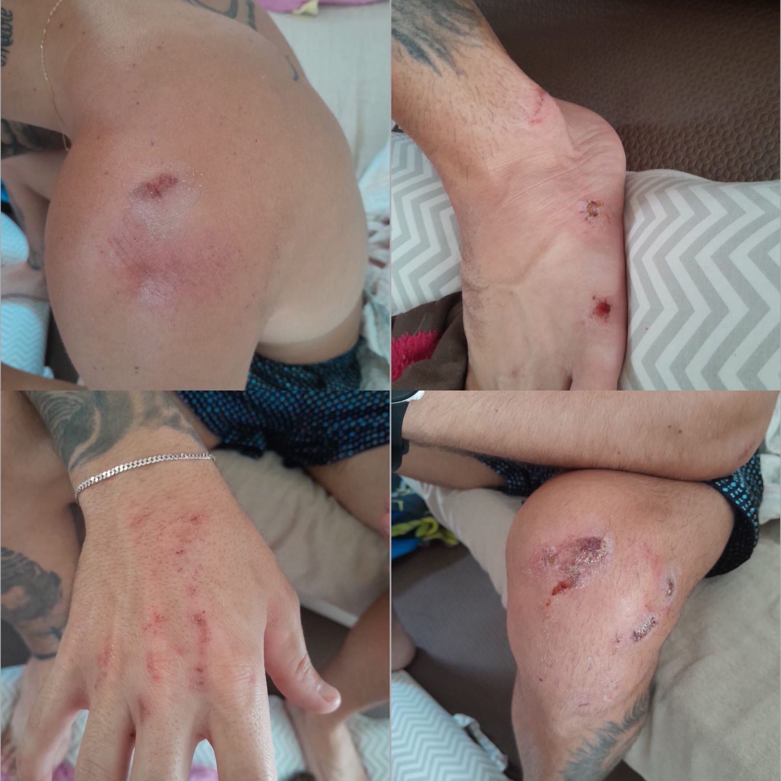 Ferimentos causados pelo ataque