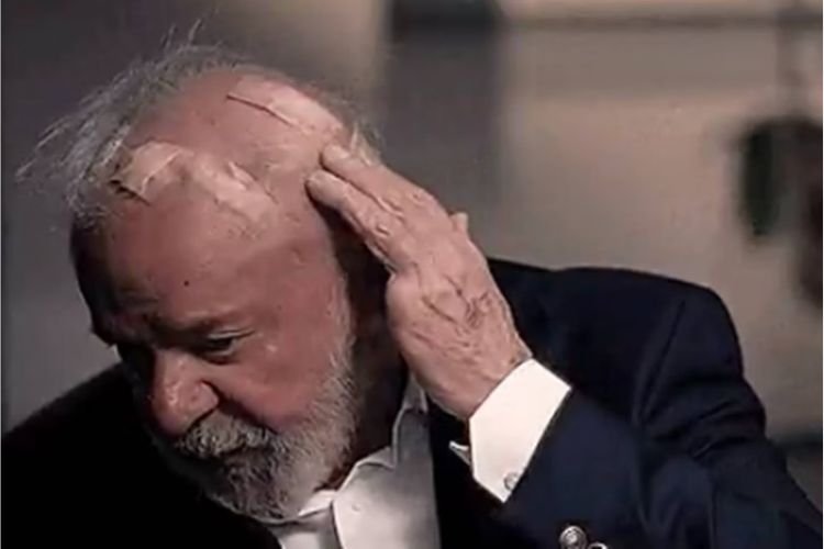 Lula sofreu um hemorragia intracraniana e passou por dois procedimentos cirúrgicos/Crédito: TV Globo / Reprodução Lula sofreu um hemorragia intracraniana e passou por dois procedimentos cirúrgicos/Crédito: TV Globo / Reprodução