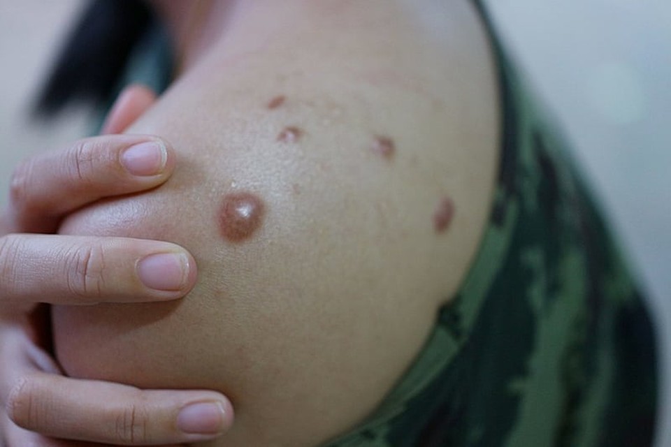 Caso foi confirmado na sexta-feira (7)/foto: Mpox Caso foi confirmado na sexta-feira (7)/foto: Mpox