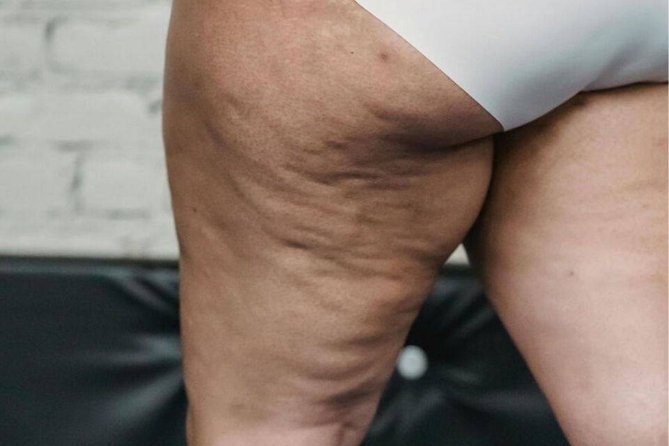 O Lipedema vai muito além de questões estéticas/foto: Julia Larson/Pexels