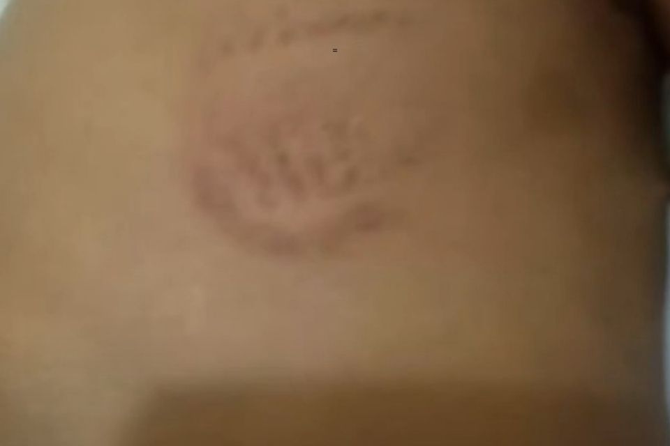Criança ficou com diversas marcas pelo corpo/Foto: Reprodução