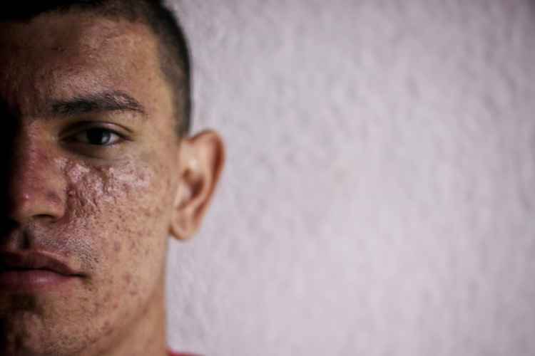 Breno conta em detalhes o passado marcado pela violência e mostra as cicatrizes que ficaram